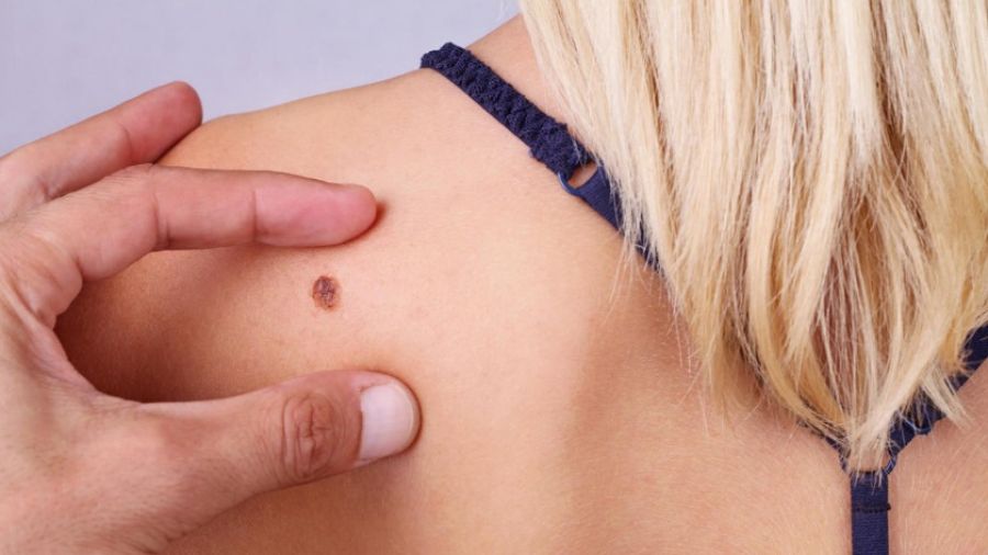 Ученые из Британии предложили неожиданный способ повысить эффективность лечения рака кожи